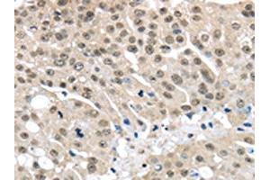 The image on the left is immunohistochemistry of paraffin-embedded Human breast cancer tissue using ABIN7130212(MED15 Antibody) at dilution 1/30, on the right is treated with fusion protein. (MED15 抗体)