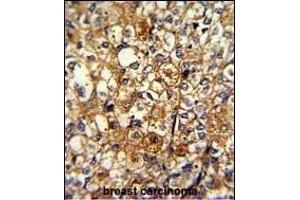 Formalin-fixed and paraffin-embedded human breast carcinoma with ACTN1 Antibody (N-term), which was peroxidase-conjugated to the secondary antibody, followed by DAB staining. (ACTN1 抗体  (N-Term))