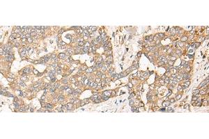 Immunohistochemistry of paraffin-embedded Human liver cancer tissue using CPNE3 Polyclonal Antibody at dilution of 1:40(x200) (Copine III 抗体)