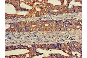 Immunohistochemistry of paraffin-embedded human colon cancer using ABIN7152131 at dilution of 1:100 (EIF2S1 抗体  (AA 276-315))
