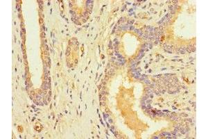 Immunohistochemistry of paraffin-embedded human prostate cancer using ABIN7168091 at dilution of 1:100 (Riboflavin Kinase 抗体  (AA 1-154))