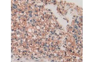 Used in DAB staining on fromalin fixed paraffin- embedded kidney cancer tissue (SPRY3 抗体  (AA 91-288))