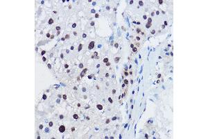 Immunohistochemistry of paraffin-embedded human liver cancer using  Rabbit pAb (ABIN7265580) at dilution of 1:150 (40x lens). (ANAPC11 抗体  (AA 1-84))