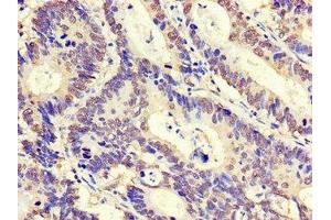Immunohistochemistry of paraffin-embedded human colon cancer using ABIN7176555 at dilution of 1:100 (ZNF844 抗体  (AA 1-300))
