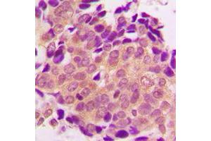 Immunohistochemical analysis of ALDOB staining in human breast cancer formalin fixed paraffin embedded tissue section. (ALDOB 抗体  (Center))