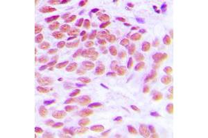 Immunohistochemical analysis of GATA1 staining in human breast cancer formalin fixed paraffin embedded tissue section. (GATA1 抗体  (Center))