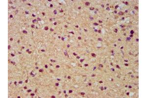 IHC image of ABIN7171980 diluted at 1:300 and staining in paraffin-embedded human glioma performed on a Leica BondTM system. (SLC19A2 抗体  (AA 209-285))