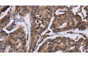 Immunohistochemistry of paraffin-embedded Human breast cancer using KIF1C Polyclonal Antibody at dilution of 1:60 (KIF1C 抗体)