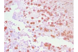 Formalin-fixed, paraffin-embedded human Melanoma stained with TYRP1 Rabbit Polyclonal Antibody using AEC Chromogen (red).