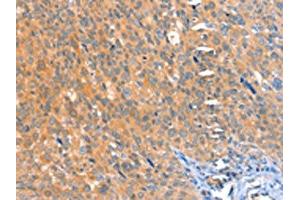 The image on the left is immunohistochemistry of paraffin-embedded Human cervical cancer tissue using ABIN7128174(ACOX3 Antibody) at dilution 1/25, on the right is treated with fusion protein. (ACOX3 抗体)