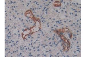 Detection of CYTH2 in Human Glioma Tissue using Polyclonal Antibody to Cytohesin 2 (CYTH2) (Cytohesin 2 抗体  (AA 1-390))