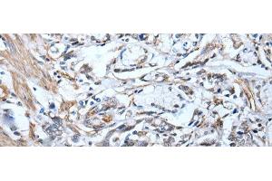 Immunohistochemistry of paraffin-embedded Human gastric cancer tissue using STRADA Polyclonal Antibody at dilution of 1:45(x200) (STRADA 抗体)