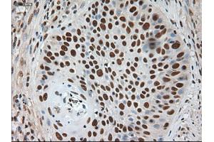 Immunohistochemical staining of paraffin-embedded Adenocarcinoma of breast using anti-Notch1 (ABIN2452671) mouse monoclonal antibody. (Notch1 抗体  (AA 2300-2556))