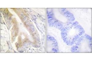 Immunohistochemistry analysis of paraffin-embedded human colon carcinoma tissue, using IREB1 (Ab-138) Antibody. (Aconitase 1 抗体  (AA 106-155))