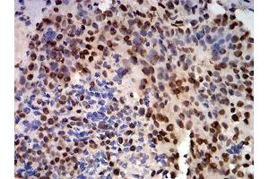 Immunohistochemical analysis of paraffin-embedded bladder cancer tissues using CIRBP mouse mAb with DAB staining.