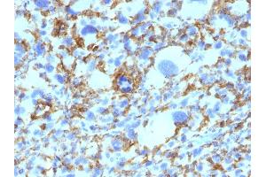 Formalin-fixed, paraffin-embedded human Histiocytoma stained with HLA-DR Monoclonal Antibody (SPM423). (HLA-DRB1 抗体)