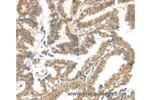 Immunohistochemistry of Human liver cancer using KCNG3 Polyclonal Antibody at dilution of 1:40 (KCNG3 抗体)