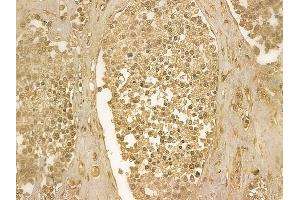 DBC1 Mouse Monoclonal Antibody at 1/100 staining human prostate carcinoma by IHC-P.