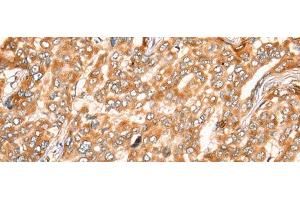 Immunohistochemistry of paraffin-embedded Human liver cancer tissue using ZMYND10 Polyclonal Antibody at dilution of 1:35(x200) (ZMYND10 抗体)