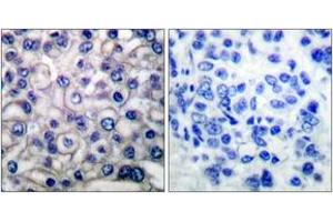 Immunohistochemistry analysis of paraffin-embedded human breast carcinoma tissue, using EGFR (Ab-693) Antibody. (EGFR 抗体  (AA 661-710))