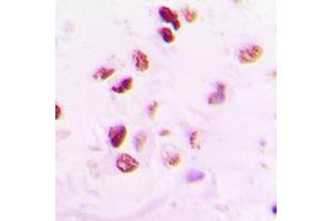 Immunohistochemical analysis of RAD50 staining in human lung cancer formalin fixed paraffin embedded tissue section. (RAD50 抗体  (Center))