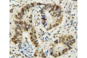 Anti-MTA1 antibody, IHC(P) IHC(P): Human Rectal Cancer Tissue (MTA1 抗体  (C-Term))