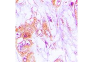Immunohistochemical analysis of CDKL4 staining in human lung cancer formalin fixed paraffin embedded tissue section. (CDKL4 抗体  (C-Term))