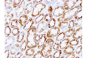 Formalin-fixed, paraffin-embedded human Renal Cell Carcinoma stained with Laminin Rat Monoclonal Antibody (A5). (Laminin gamma 1 抗体)