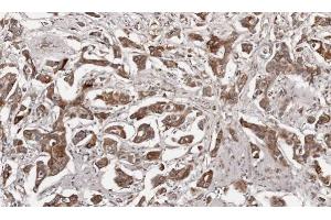 IHC-P Image Immunohistochemical analysis of paraffin-embedded human breast cancer, using Growth Hormone, antibody at 1:100 dilution. (Growth Hormone 1 抗体)