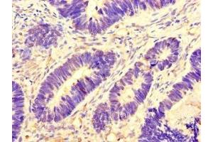 Immunohistochemistry of paraffin-embedded human ovarian cancer using ABIN7145075 at dilution of 1:100