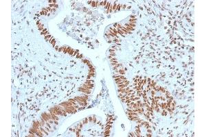 Formalin-fixed, paraffin-embedded human Colon Carcinoma stained with Nucleophosmin-Monospecific Mouse Monoclonal Antibody (NPM1/1902).