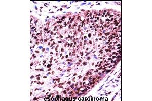 SF3B1 Antibody (N-term) ((ABIN657676 and ABIN2846668))immunohistochemistry analysis in formalin fixed and paraffin embedded human esophagus carcinoma followed by peroxidase conjugation of the secondary antibody and DAB staining.