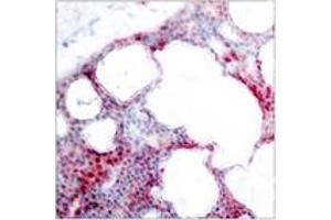 Immunohistochemistry analysis of paraffin-embedded human breast carcinoma, using ATF2 (Phospho-Ser62 or 44) Antibody. (ATF2 抗体  (pSer62))