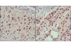 Immunohistochemical analysis of paraffin-embedded human lung cancer (left) and cervical carcinoma (right), showing nuclear localization using ISL1 mouse mAb with DAB staining. (ISL1 抗体)
