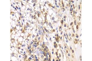 Immunohistochemistry of paraffin-embedded Human kidney cancer using SRPK1 Polyclonal Antibody at dilution of 1:200 (40x lens). (SRPK1 抗体)