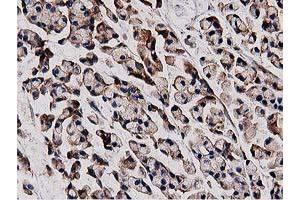 Immunohistochemical staining of paraffin-embedded Adenocarcinoma of Human colon tissue using anti-HDAC6 mouse monoclonal antibody. (HDAC6 抗体)