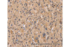 Immunohistochemistry of Human liver cancer using PPIF Polyclonal Antibody at dilution of 1:60 (PPIF 抗体)