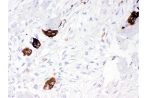 Cathepsin K was detected in paraffin-embedded sections of human osteosarcoma tissues using rabbit anti- Cathepsin K Antigen Affinity purified polyclonal antibody at 1 μg/mL. (Cathepsin K 抗体  (AA 115-329))