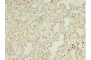 Immunohistochemistry of paraffin-embedded human breast cancer using ABIN7158260 at dilution of 1:100 (LILRA4 抗体  (AA 289-424))