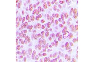 Immunohistochemical analysis of c-Jun (pY170) staining in human breast cancer formalin fixed paraffin embedded tissue section.