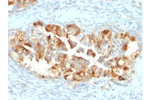 Formalin-fixed, paraffin-embedded human Endometrial Carcinoma stained with Mesothelin Mouse Monoclonal Antibody (MSLN/2131). (Mesothelin 抗体  (AA 273-407))