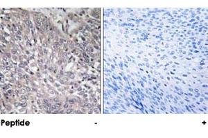 Immunohistochemical analysis of paraffin-embedded human cervix carcinoma tissue using ITPR1 polyclonal antibody . (ITPR1 抗体)