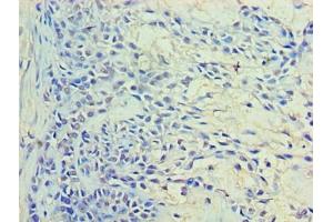 Immunohistochemistry of paraffin-embedded human breast cancer using ABIN7167221 at dilution of 1:100 (RAB11A 抗体  (AA 2-213))