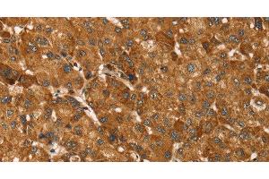 Immunohistochemistry of paraffin-embedded Human liver cancer tissue using TBC1D1 Polyclonal Antibody at dilution 1:45 (TBC1D1 抗体)