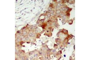Immunohistochemical analysis of POTEB staining in human prostate cancer formalin fixed paraffin embedded tissue section. (POTEB 抗体  (C-Term))