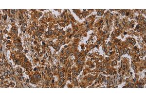 Immunohistochemistry of paraffin-embedded Human liver cancer tissue using ATP2A1 Polyclonal Antibody at dilution 1:30 (ATP2A1/SERCA1 抗体)
