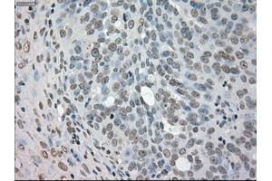 Immunohistochemical staining of paraffin-embedded Adenocarcinoma of colon tissue using anti-NEK6mouse monoclonal antibody. (NEK6 抗体)