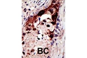 Formalin-fixed and paraffin-embedded human cancer tissue reacted with the primary antibody, which was peroxidase-conjugated to the secondary antibody, followed by AEC staining. (Epsin 2 抗体  (N-Term))