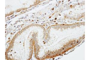 IHC-P Image Immunohistochemical analysis of paraffin-embedded human gastric cancer, using Coronin 1A, antibody at 1:100 dilution. (Coronin 1a 抗体  (C-Term))