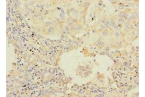 Immunohistochemistry of paraffin-embedded human lung cancer using ABIN7154845 at dilution of 1:100 (HAND1 抗体  (AA 16-215))